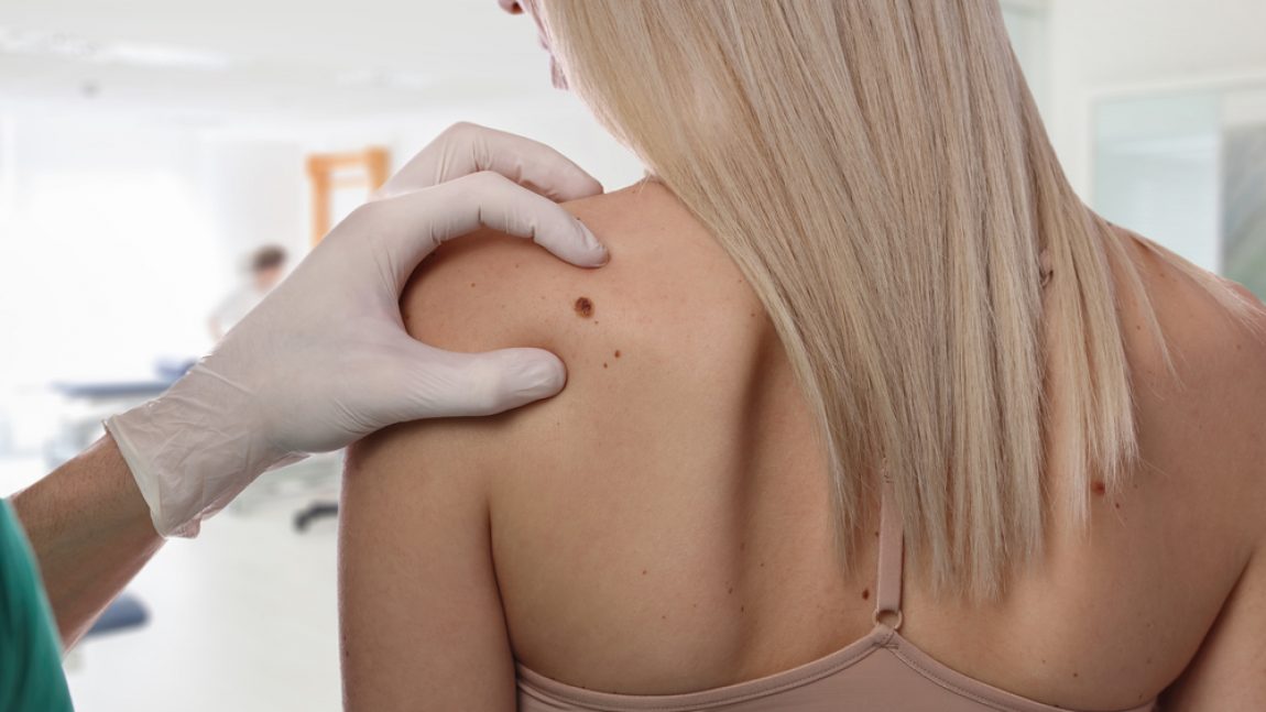 When to Consider Brown Spot Removal Treatment