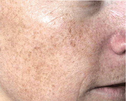 Laser Brown Spot Removal before