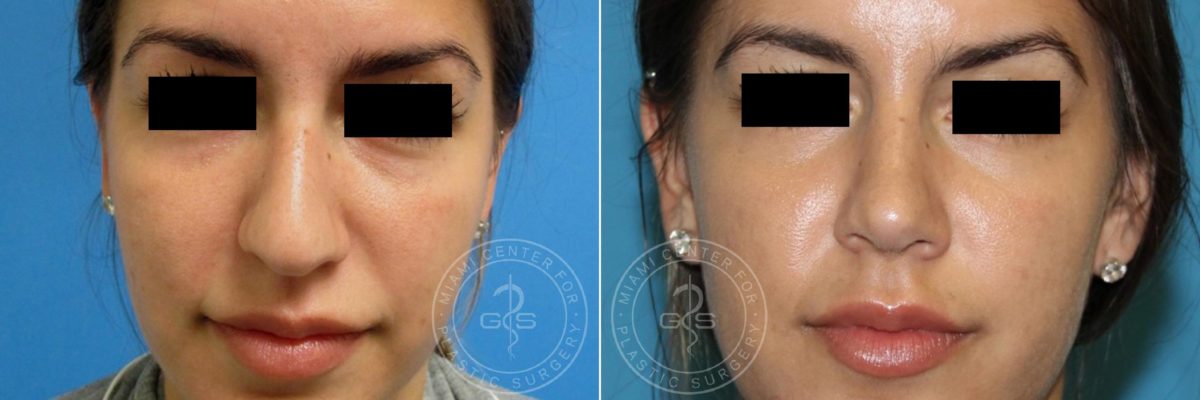 Rhinoplasty before and after photos in Miami Beach, FL, Patient 3242