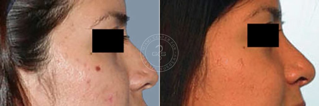 patient-2613-rhinoplasty-before-after