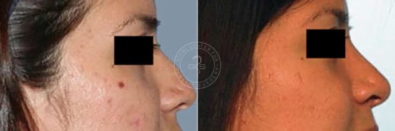 Rhinoplasty before and after photos in Miami Beach, FL, Patient 2613