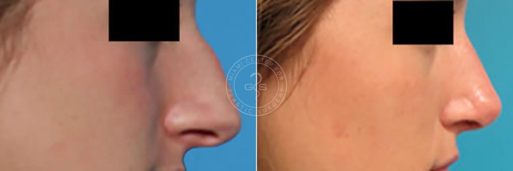 patient-2613-rhinoplasty-before-after