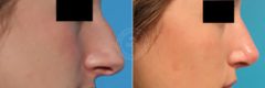 Rhinoplasty before and after photos in Miami Beach, FL, Patient 3199