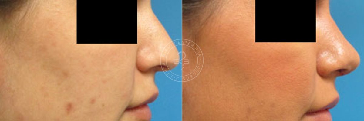 Rhinoplasty before and after photos in Miami Beach, FL, Patient 3203