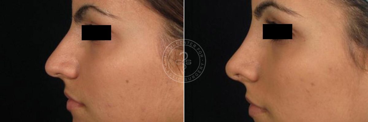 Rhinoplasty before and after photos in Miami Beach, FL, Patient 3209