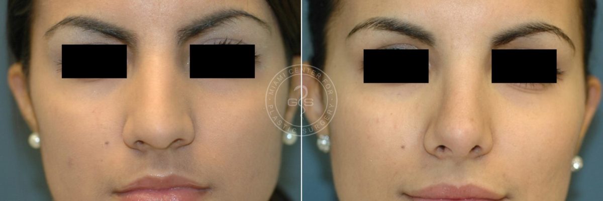 Rhinoplasty before and after photos in Miami Beach, FL, Patient 3209