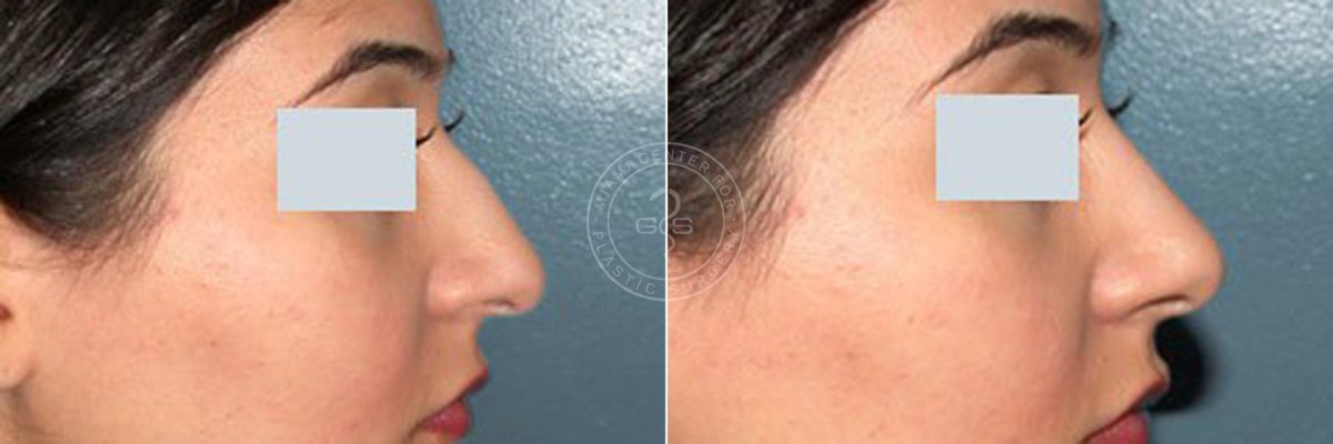 Rhinoplasty before and after photos in Miami Beach, FL, Patient 3219