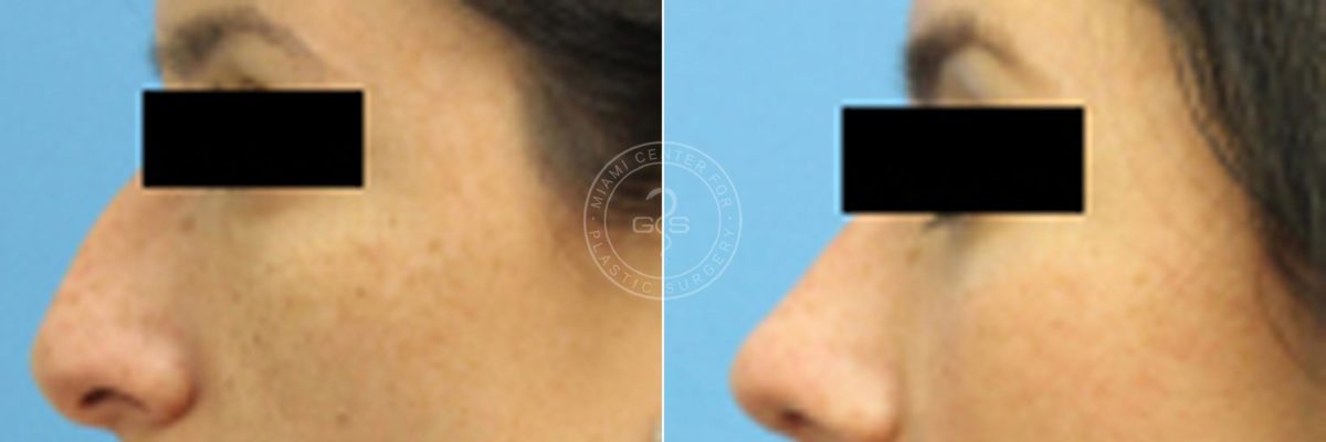 Rhinoplasty before and after photos in Miami Beach, FL, Patient 3226