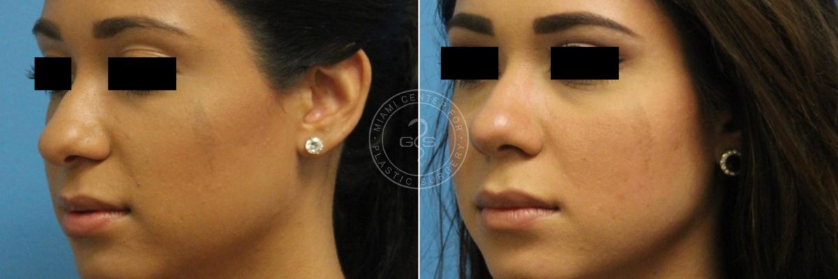 Rhinoplasty before and after photos in Miami Beach, FL, Patient 3230