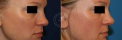 Rhinoplasty before and after photos in Miami Beach, FL, Patient 3238