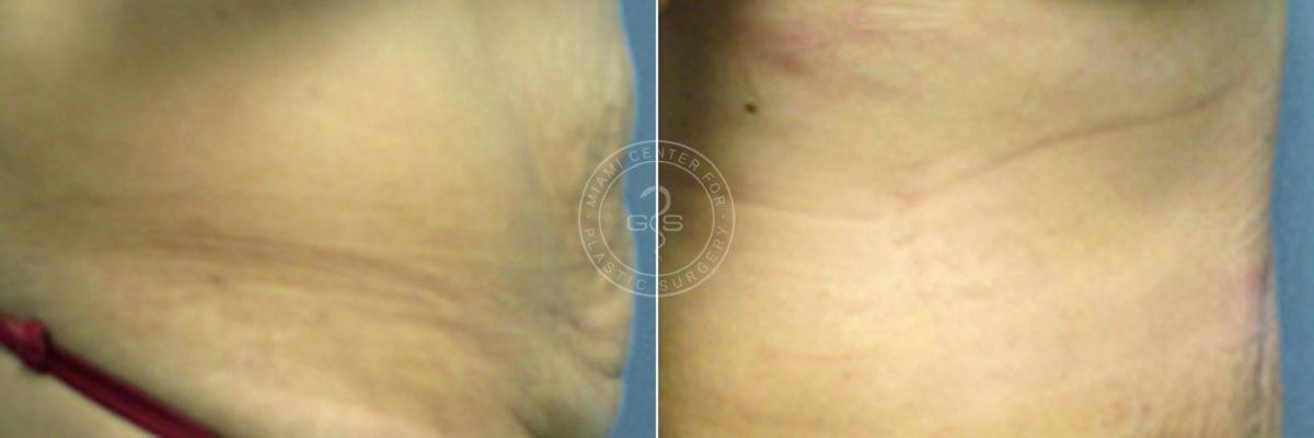 Abdominoplasty before and after photos in Miami Beach, FL, Patient 2628