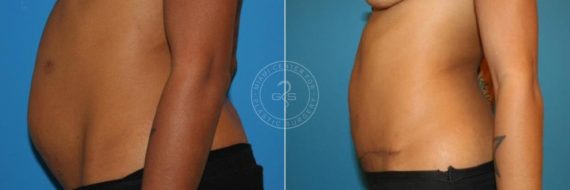 Abdominoplasty before and after photos in Miami Beach, FL, Patient 2905