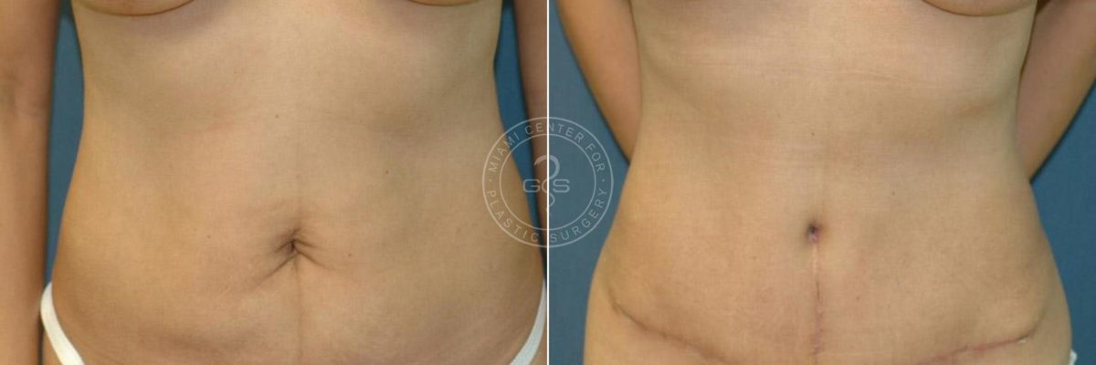 Abdominoplasty before and after photos in Miami Beach, FL, Patient 2909