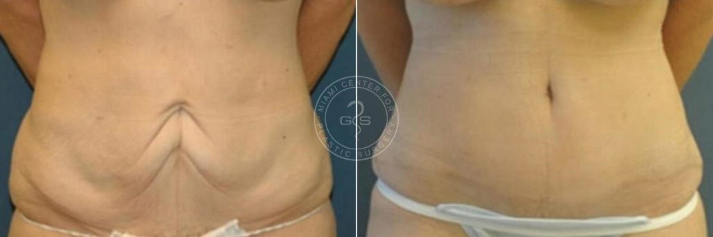 patient-2628-abdominoplasty-before-after