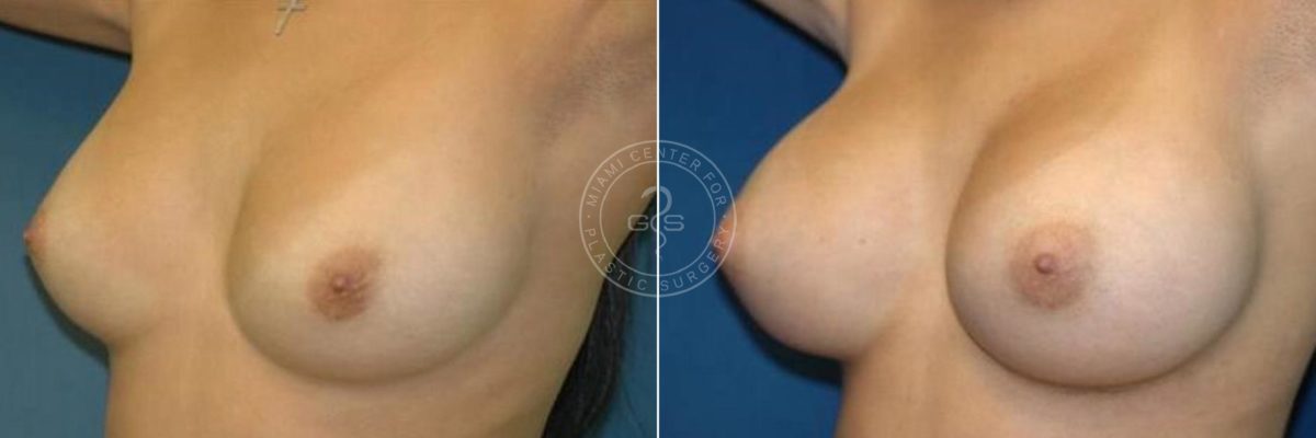 Breast Augmentation before and after photos in Miami Beach, FL, Patient 2638