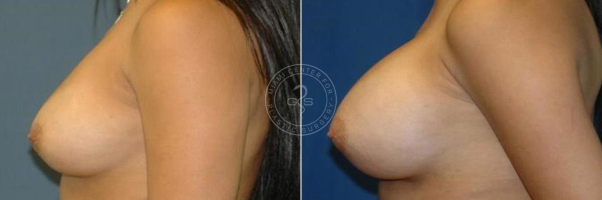 Breast Augmentation before and after photos in Miami Beach, FL, Patient 2638