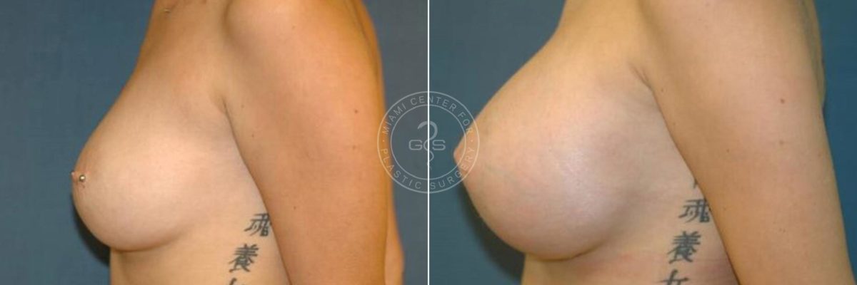 Breast Augmentation before and after photos in Miami Beach, FL, Patient 2657