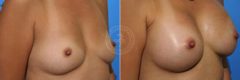 Breast Augmentation before and after photos in Miami Beach, FL, Patient 2674