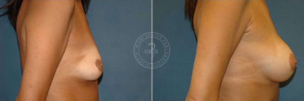Breast Augmentation before and after photos in Miami Beach, FL, Patient 2687