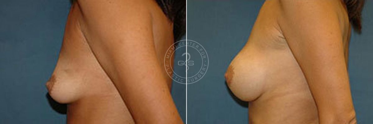 Breast Augmentation before and after photos in Miami Beach, FL, Patient 2687