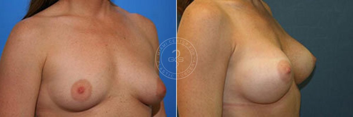 Breast Augmentation before and after photos in Miami Beach, FL, Patient 2717