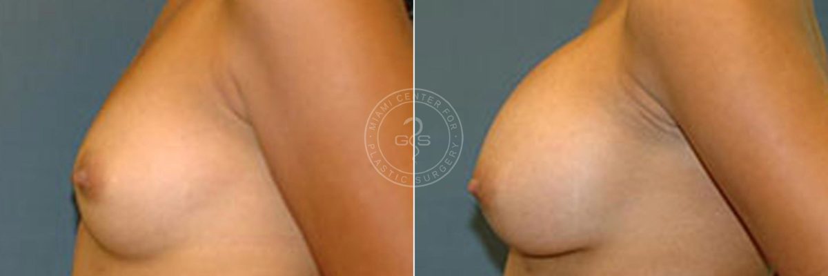 Breast Augmentation before and after photos in Miami Beach, FL, Patient 2730