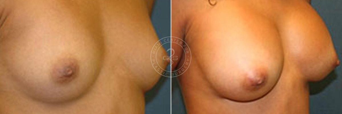 Breast Augmentation before and after photos in Miami Beach, FL, Patient 2730