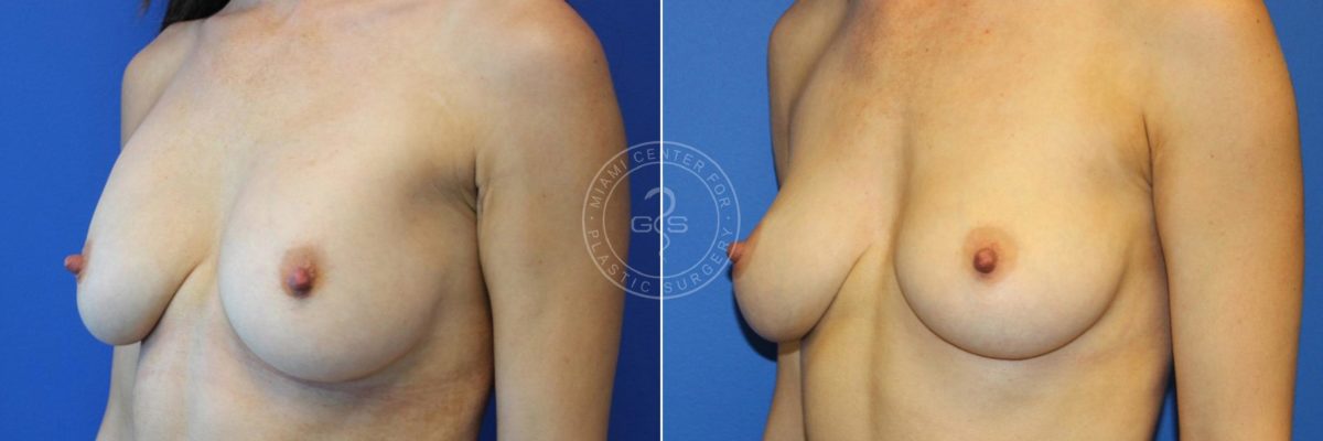 Breast Augmentation before and after photos in Miami Beach, FL, Patient 3712