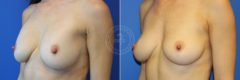 Breast Augmentation before and after photos in Miami Beach, FL, Patient 3712