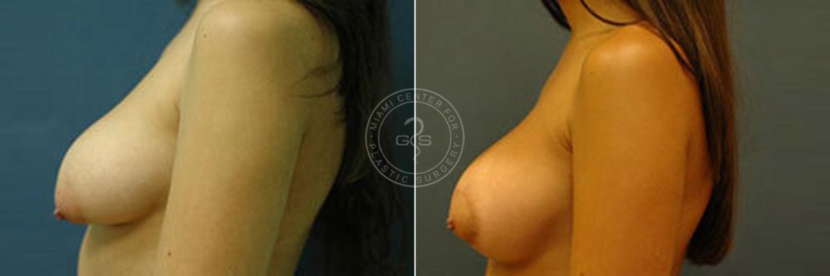 Breast Correction before and after photos in Miami Beach, FL, Patient 2741