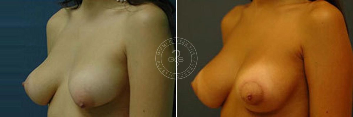 Breast Correction before and after photos in Miami Beach, FL, Patient 2741