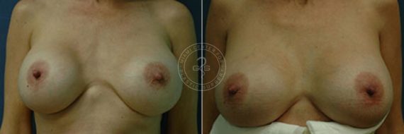 Breast Correction before and after photos in Miami Beach, FL, Patient 2758