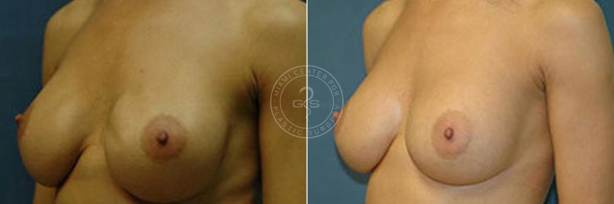 Breast Correction before and after photos in Miami Beach, FL, Patient 2762
