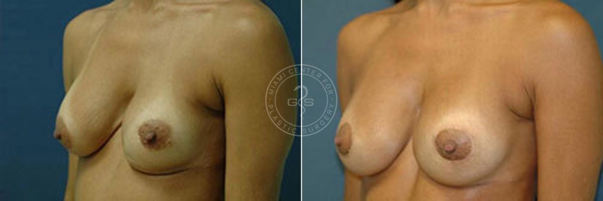 Breast Correction before and after photos in Miami Beach, FL, Patient 2775
