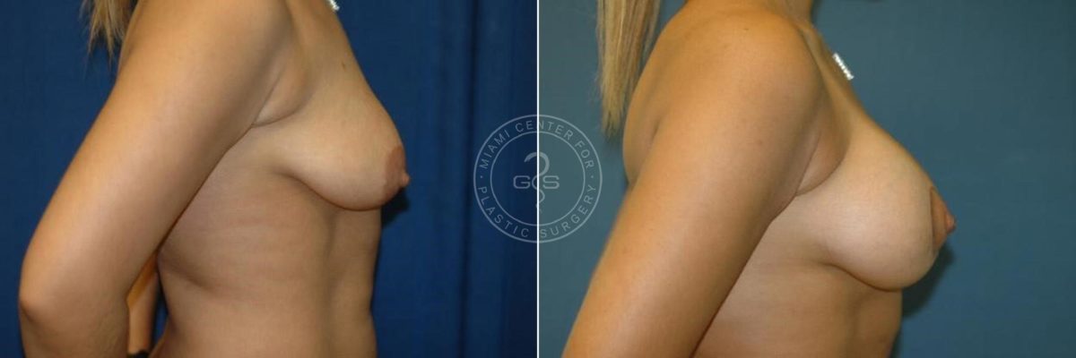 Breast Lift before and after photos in Miami Beach, FL, Patient 2792