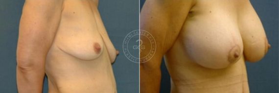 Breast Lift before and after photos in Miami Beach, FL, Patient 2811