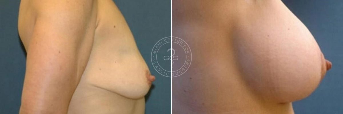 Breast Lift before and after photos in Miami Beach, FL, Patient 2811