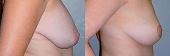Breast Lift before and after photos in Miami Beach, FL, Patient 2821