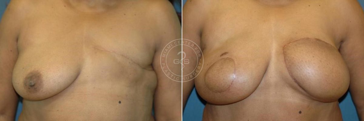 Breast Reconstruction before and after photos in Miami Beach, FL, Patient 2839