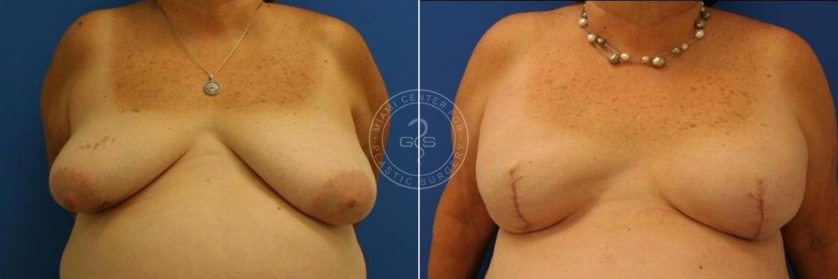 Breast Reconstruction before and after photos in Miami Beach, FL, Patient 2835