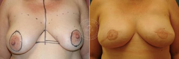 Breast Reconstruction before and after photos in Miami Beach, FL, Patient 2847