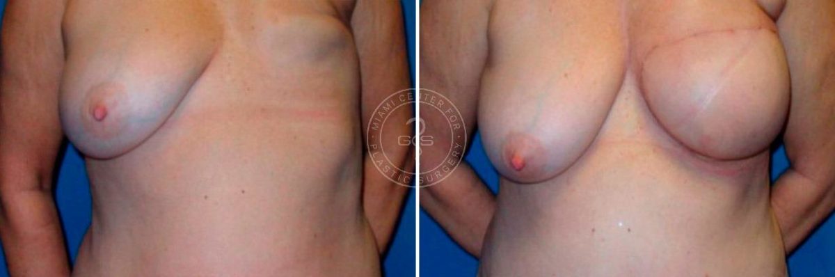 Breast Reconstruction before and after photos in Miami Beach, FL, Patient 3612
