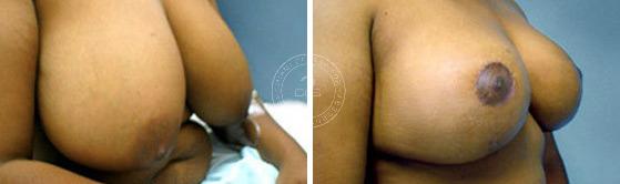 Breast Reduction before and after photos in Miami Beach, FL, Patient 2855