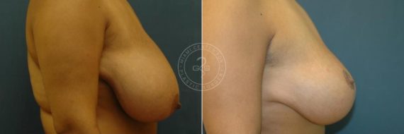 Breast Reduction before and after photos in Miami Beach, FL, Patient 3576