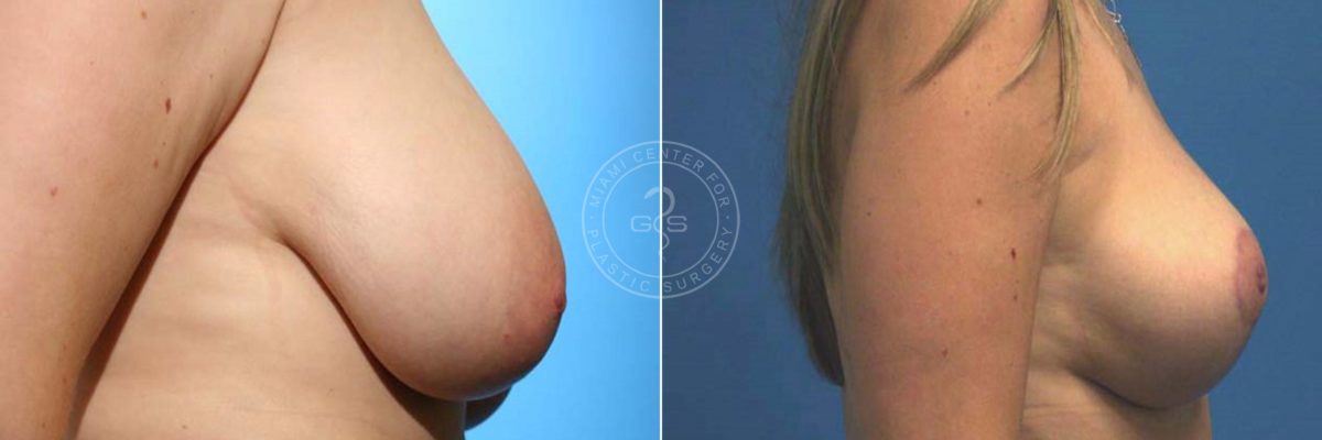 Breast Reduction before and after photos in Miami Beach, FL, Patient 3583