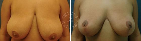 Breast Reduction before and after photos in Miami Beach, FL, Patient 2862
