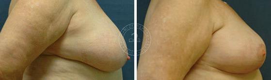 Breast Reduction before and after photos in Miami Beach, FL, Patient 2869