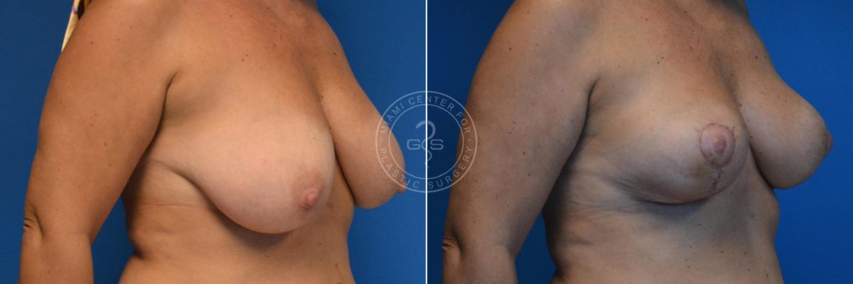Breast Reduction before and after photos in Miami Beach, FL, Patient 3566