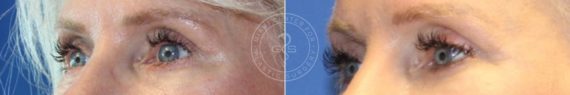 Blepharoplasty before and after photos in Miami Beach, FL, Patient 2951