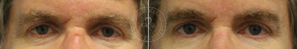 Blepharoplasty before and after photos in Miami Beach, FL, Patient 2955